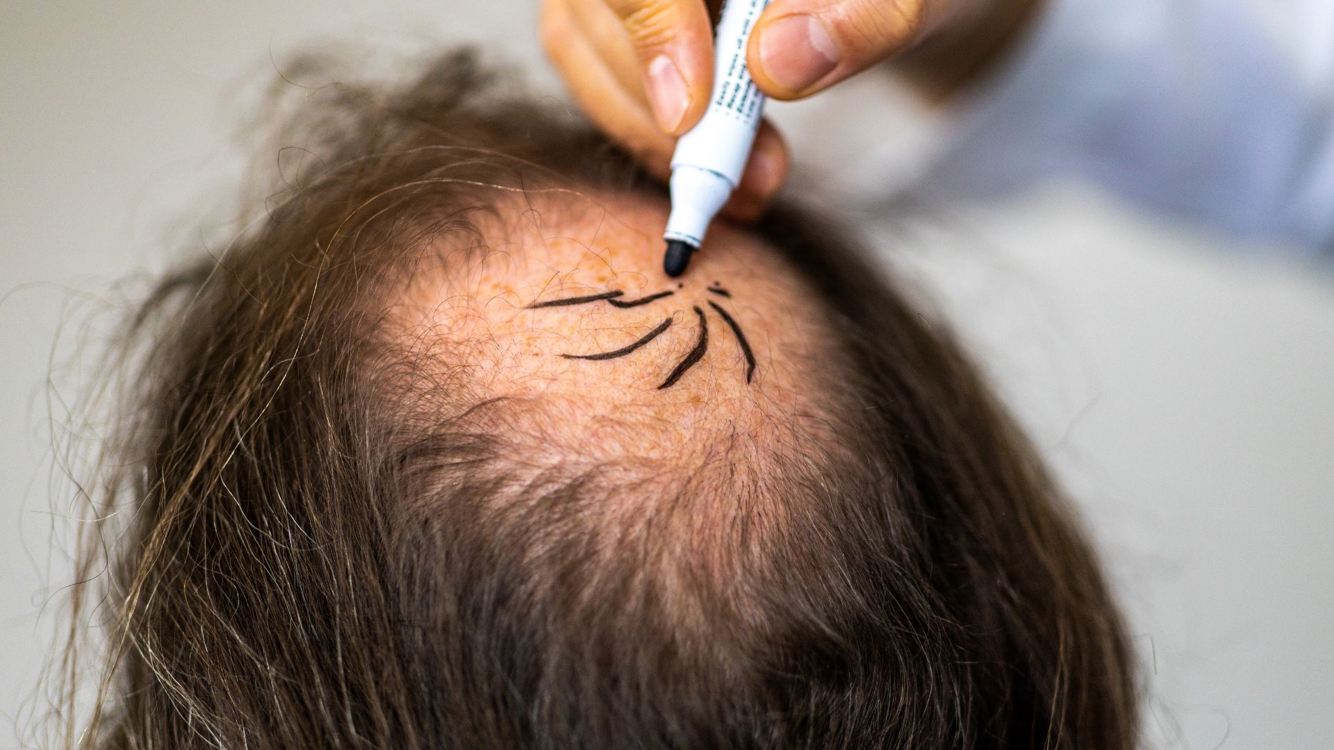 Explore the benefits and costs of FUE hair transplant in India. Learn about the procedure, recovery, and how it boosts confidence.