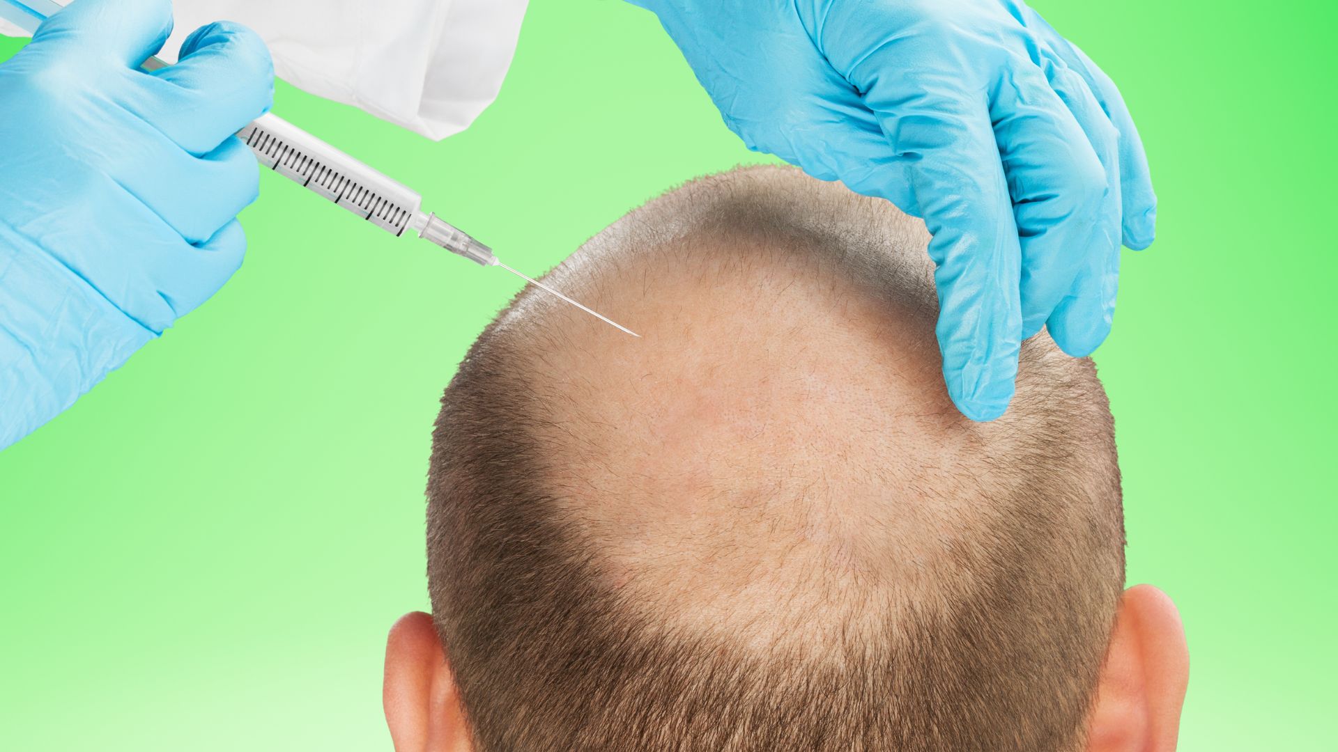 2000 grafts hair transplant cost